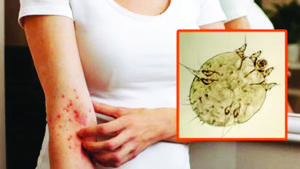 მუნის შემოტევა: ყველაფერი, რაც ამ დაავადებაზე უნდა ვიცოდეთ - "ეს არ არის უბრალოდ „ქავილი, ეს არის სო...