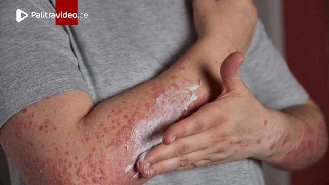 სამ სკოლაში მუნის შემთხვევა დაფიქსირდა - რა ინფორმაცია ვრცელდება ქუთაისიდან სამ სკოლაში მუნის შემთხვევა დაფიქსირდა - რა ინფორმაცია ვრცელდება ქუთაისიდან